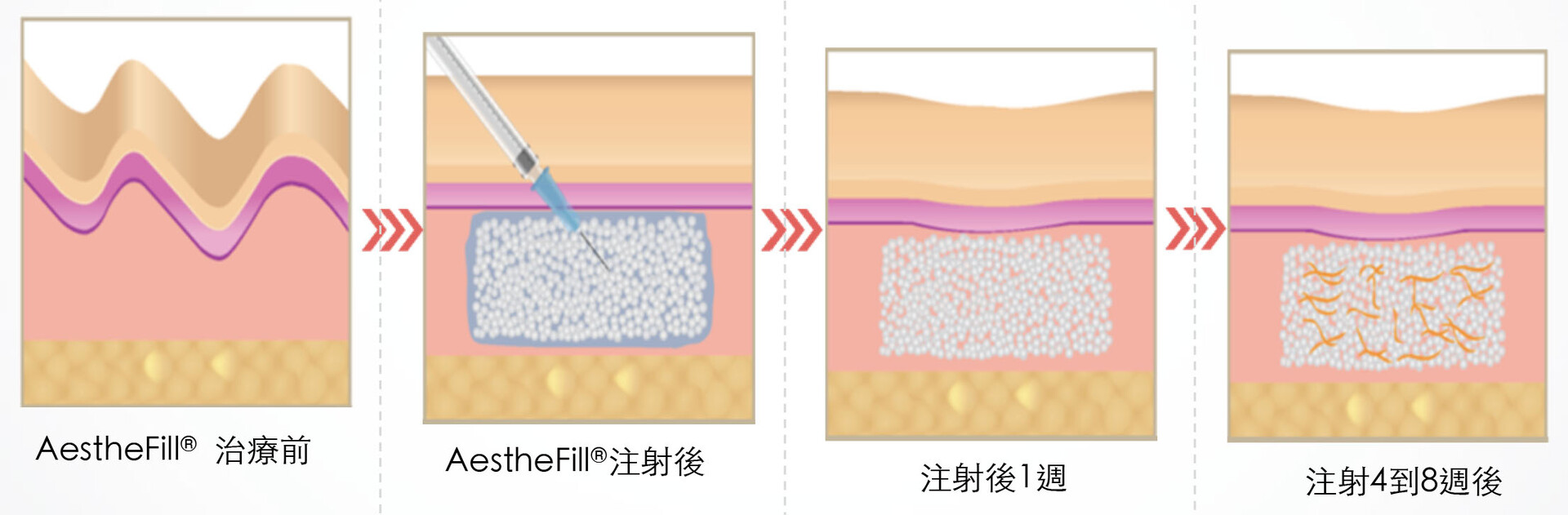 台中精靈針注射後效果
