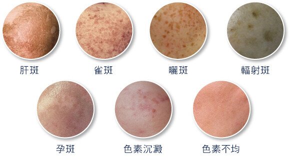 皮秒雷射有效改善肝斑、雀斑、孕班、痘疤、凹疤