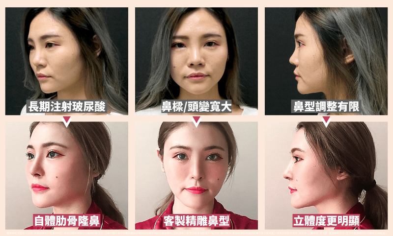 為何有人注射玻尿酸後鼻子變寬?