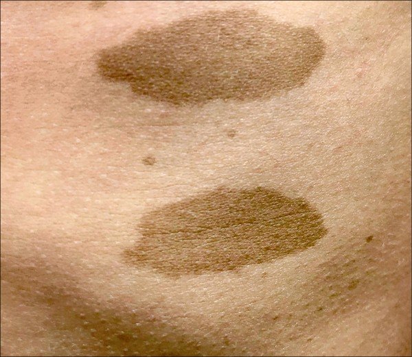 咖啡牛奶斑要當心