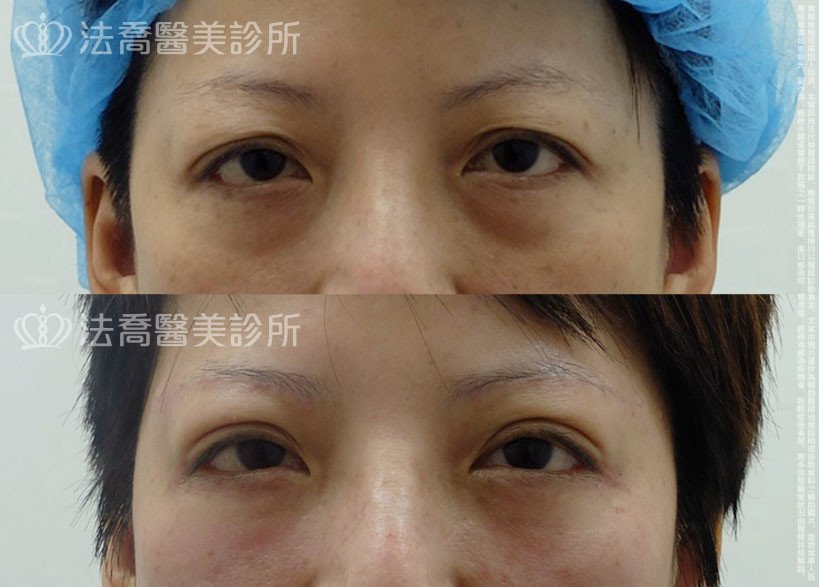 法喬醫美診所邱浚彥醫師眼袋外開切眉