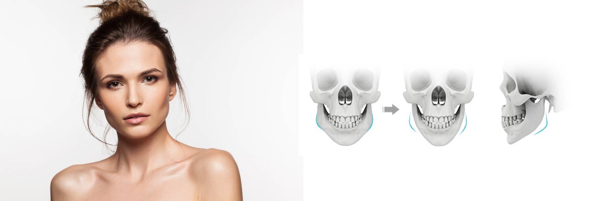 削骨手術示意圖