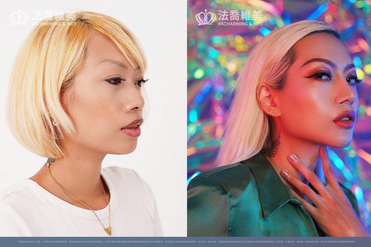 自體肋骨隆鼻案例