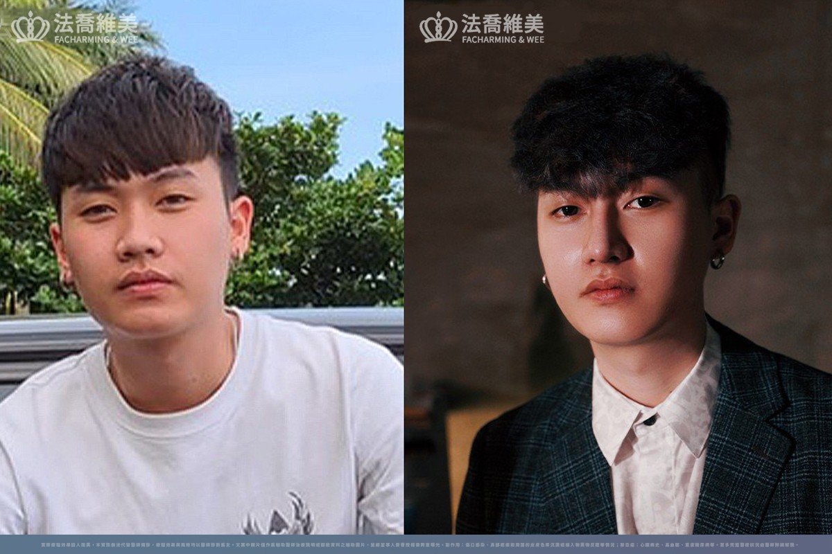 自體肋骨隆鼻案例